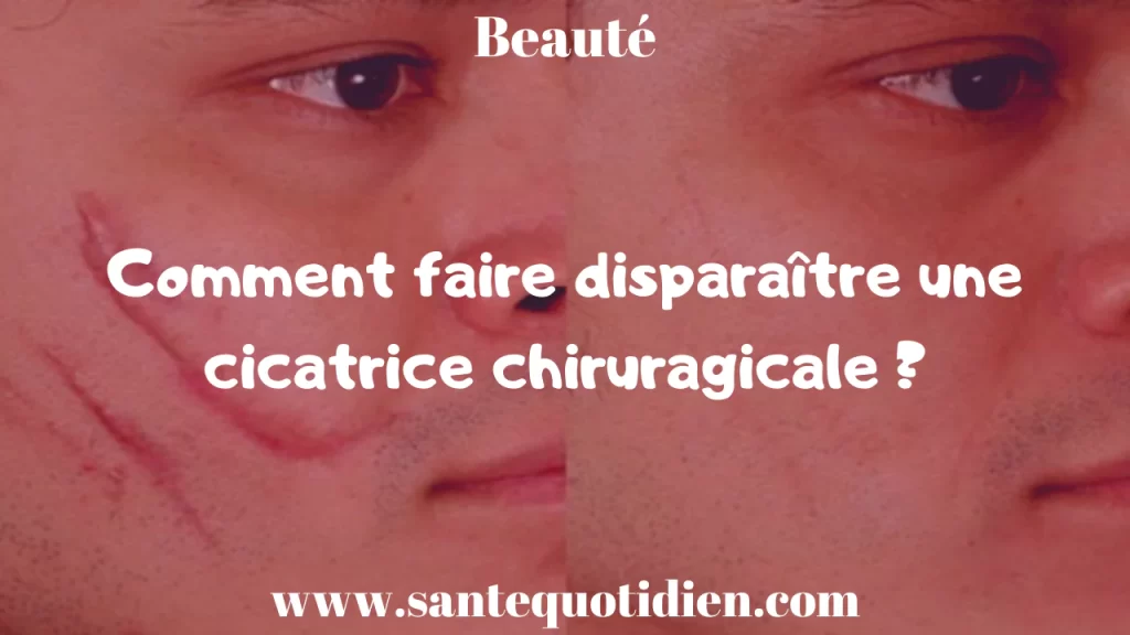 comment faire disparaitre une cicatrice chiruragicale f1ae0a73 701c 4bb8 850a b8fe5f2e87b8 1280x