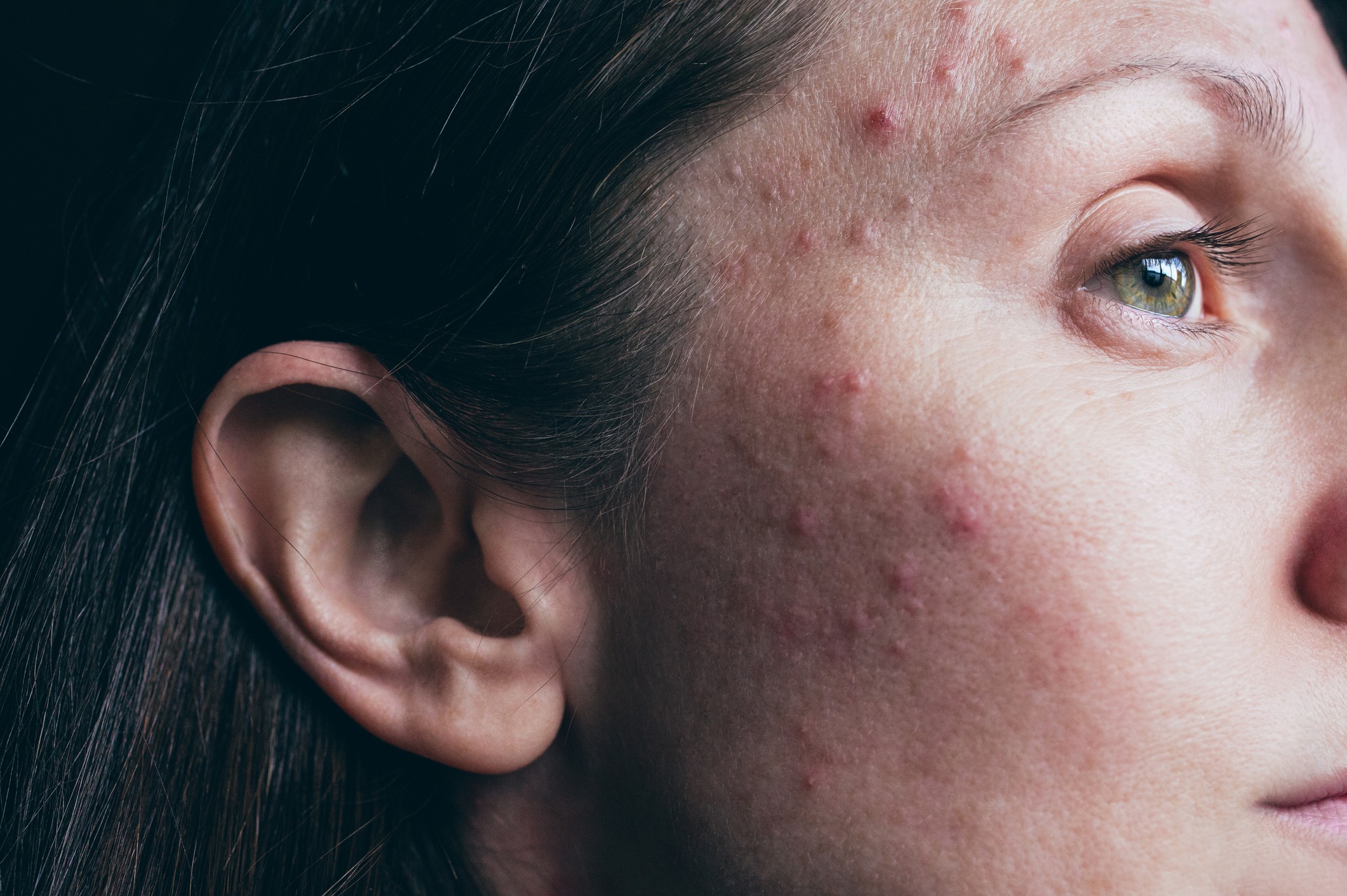 boutons de chaleur ou allergie