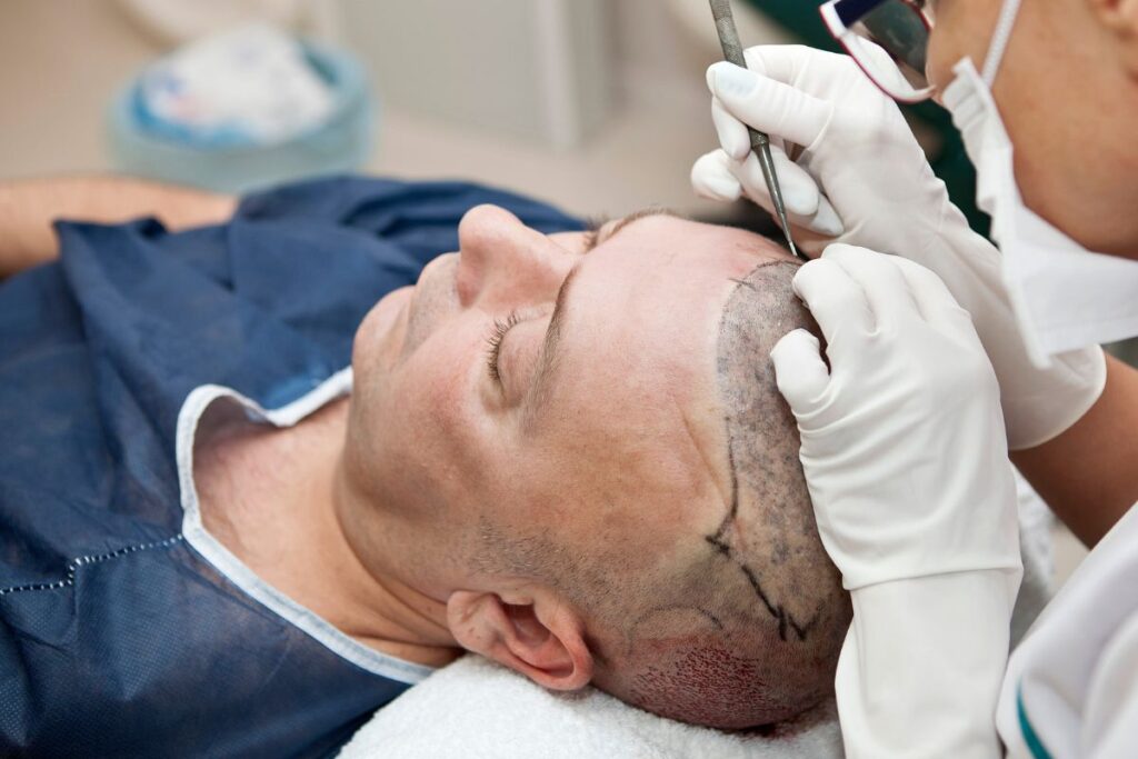 recourir à la technique d’extractions folliculaires quel est le processus